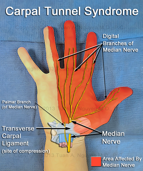 Image shows carpal tunnel syndrome